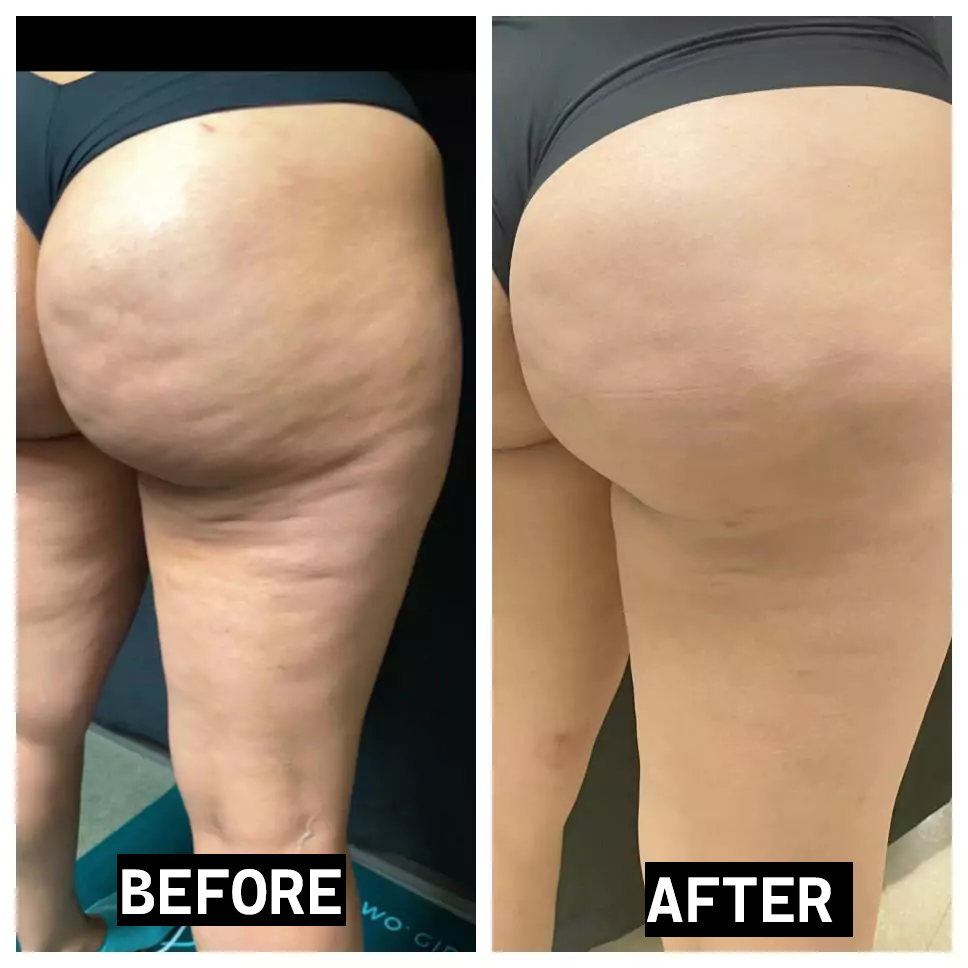 Anti-Cellulite Cream