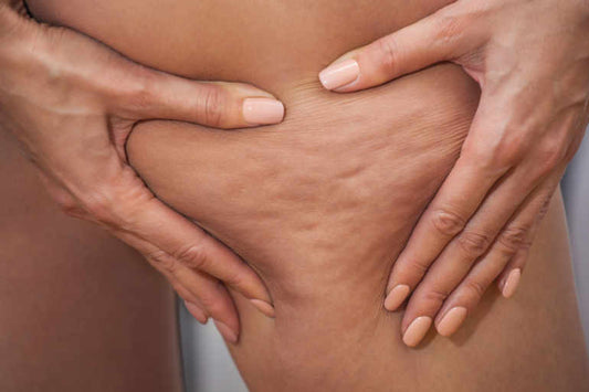 5 Everyday Habits That Can Help Reduce Cellulite Naturally